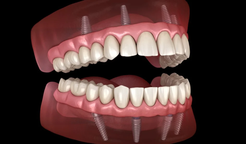 all-on-4-1170x694-1