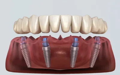 all-on-4-dental-implants-lower-jaw-illustration-1_1746464010