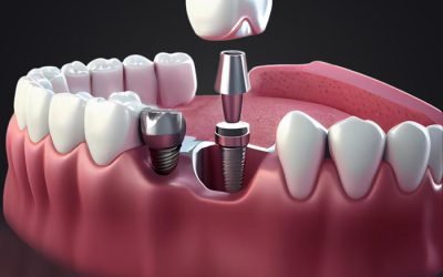 immediate-implant