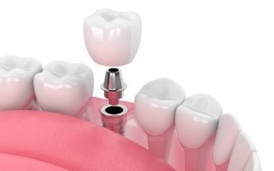 3d,Render,Of,Jaw,With,Dental,Implant,Isolated,Over,White